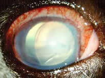 Glaukom mit Linsenluxation
